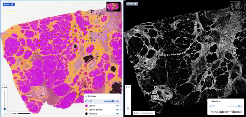 Demo of PathExploreTM Fibrosis on TCGA H&E whole slide image.
